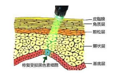 美国新一代308准分子光.jpg